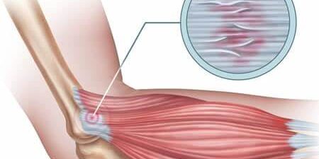 tendinopatias-fisioterapia-i-salut-lagarriga